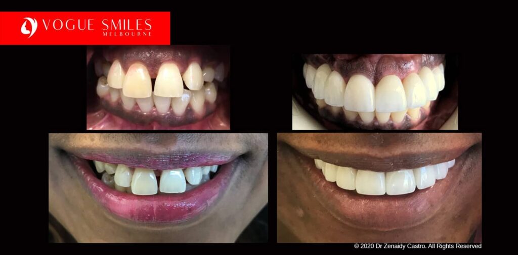 Full-Mouth-Reconstruction-complete-extreme-dental-makeover