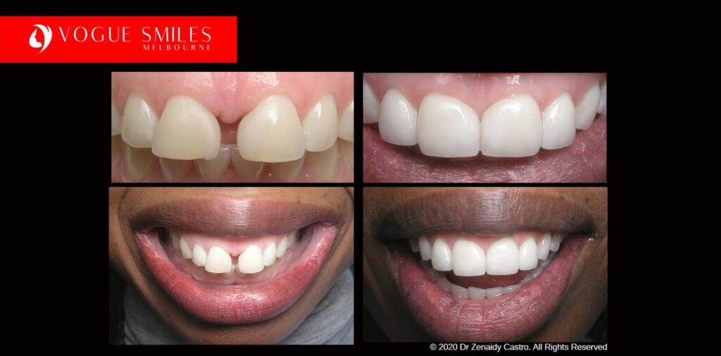 Full-Mouth-Reconstruction-complete-extreme-dental-makeover