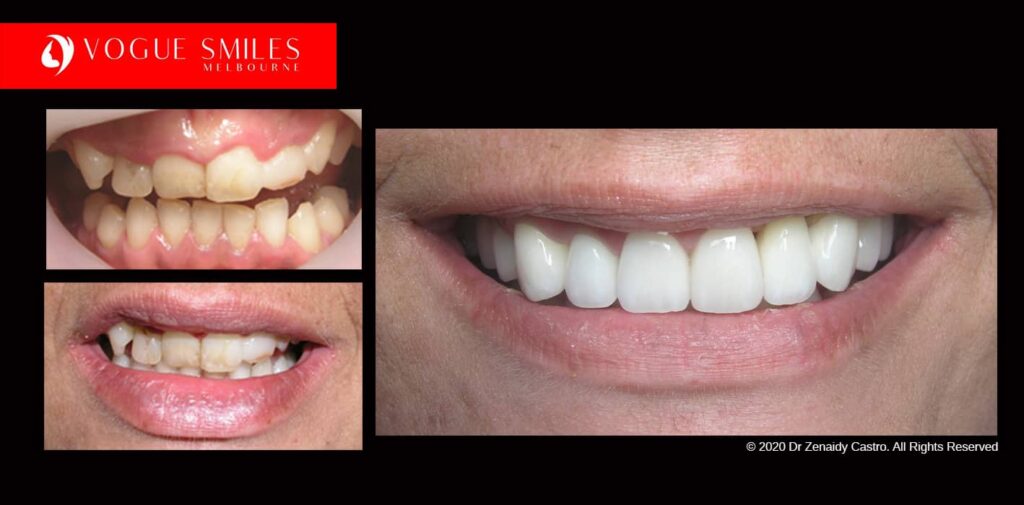 Full-Mouth-Reconstruction-complete-extreme-dental-makeover