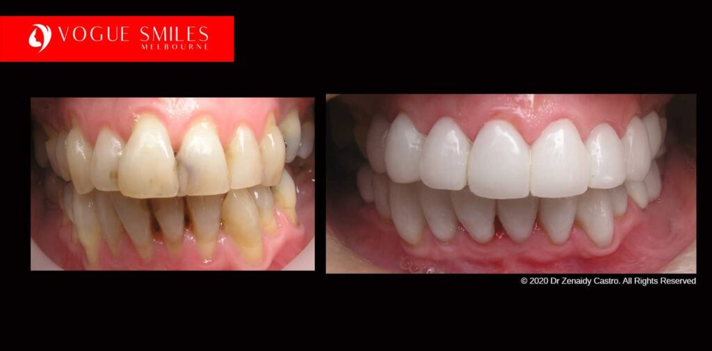 Full-Mouth-Reconstruction-complete-extreme-dental-makeover