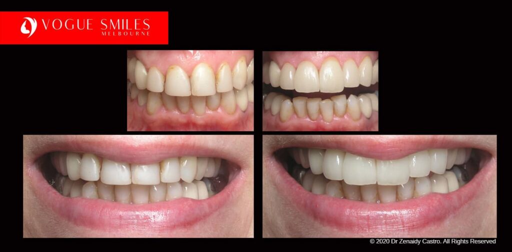 Full-Mouth-Reconstruction-complete-extreme-dental-makeover