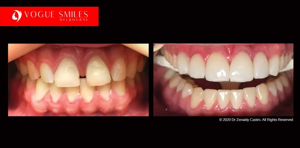 Full-Mouth-Reconstruction-complete-extreme-dental-makeover