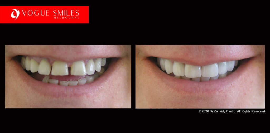 Full-Mouth-Reconstruction-complete-extreme-dental-makeover