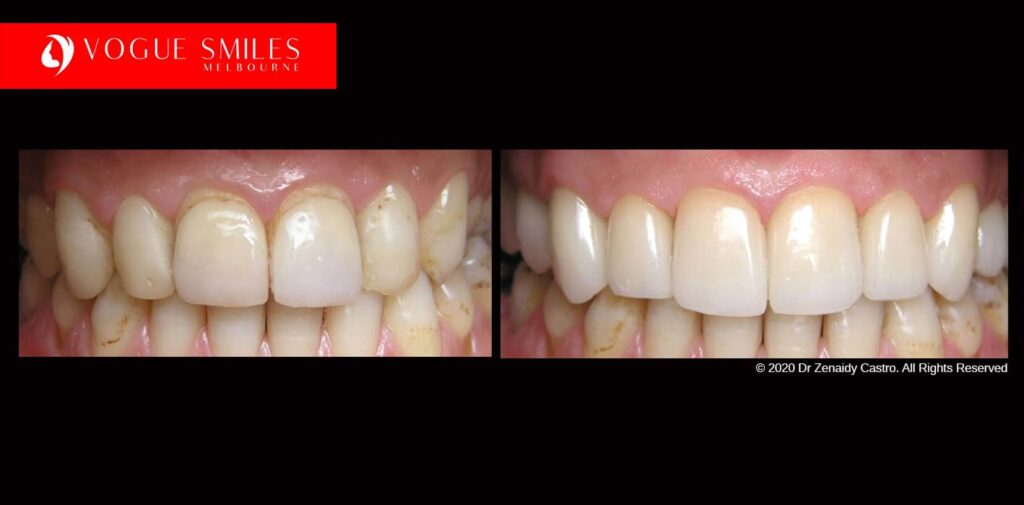 Full-Mouth-Reconstruction-complete-extreme-dental-makeover