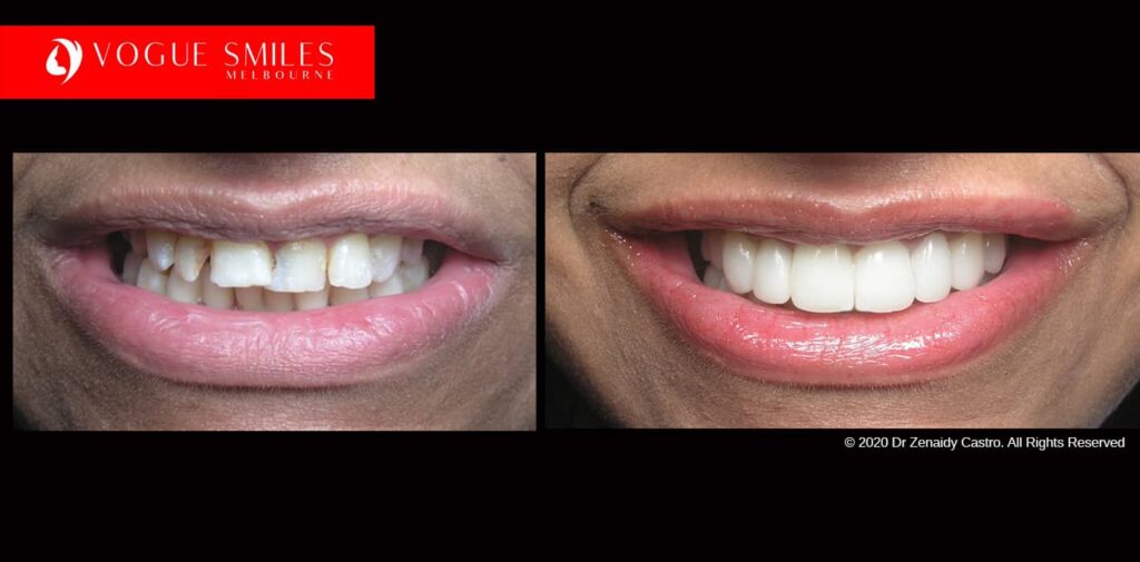 Full-Mouth-Reconstruction-complete-extreme-dental-makeover