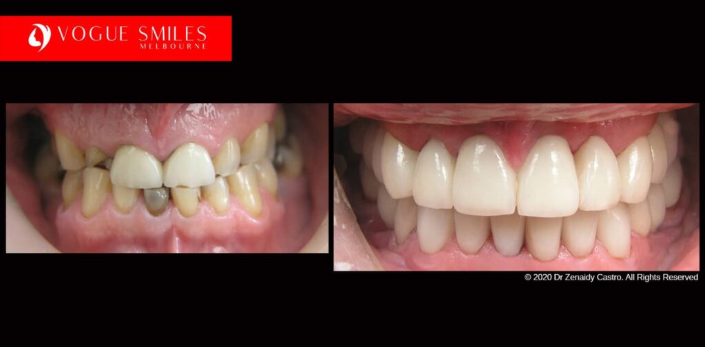 Full-Mouth-Reconstruction-complete-extreme-dental-makeover