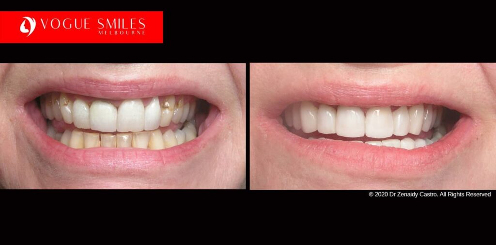 Full-Mouth-Reconstruction-complete-extreme-dental-makeover