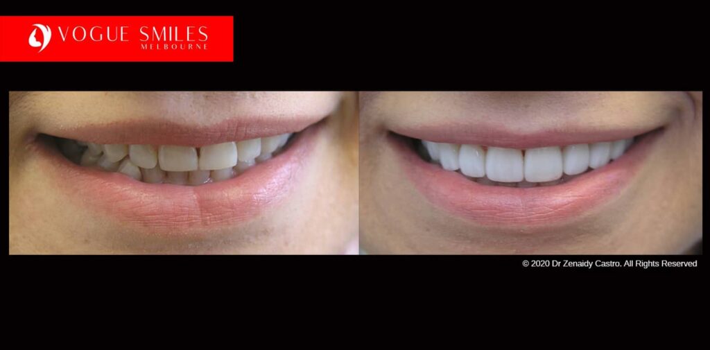 Vogue Smiles Melbourne - Vogue Dentist - Vogue Dental Melbourne -Best Cosmetic dentist in Noble park North and Melbourne CBD