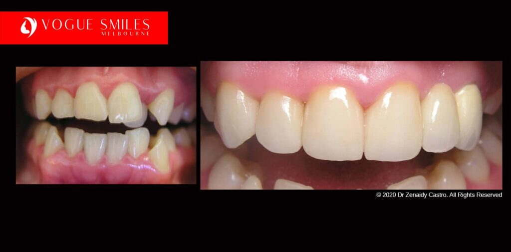 Full-Mouth-Reconstruction-complete-extreme-dental-makeover