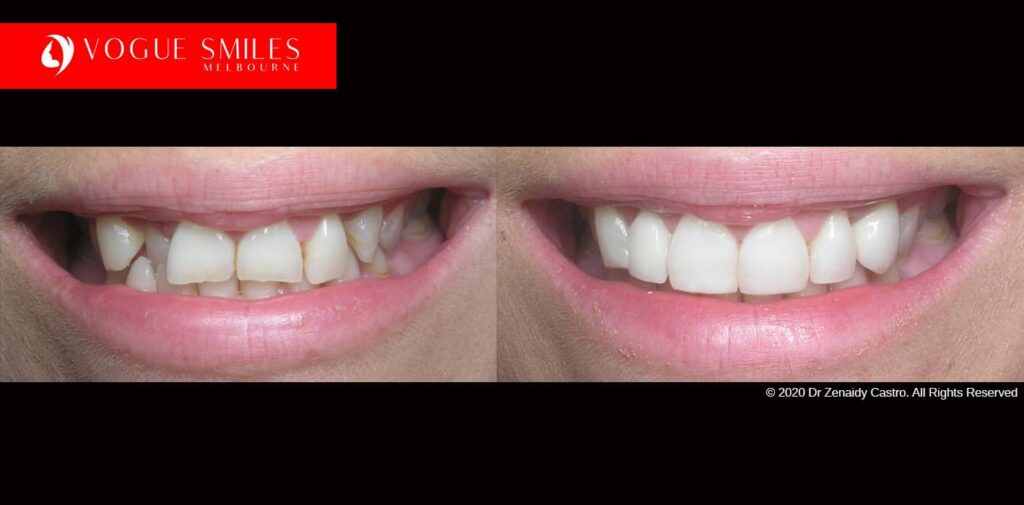 Full-Mouth-Reconstruction-complete-extreme-dental-makeover
