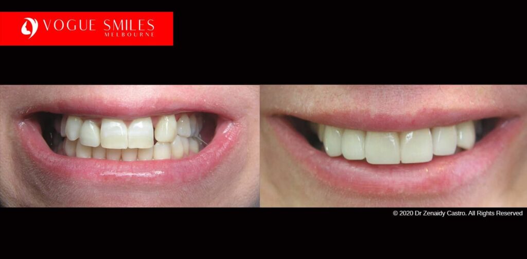 Full-Mouth-Reconstruction-complete-extreme-dental-makeover