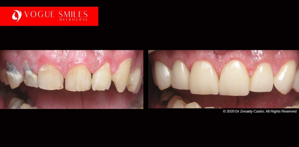 Full-Mouth-Reconstruction-complete-extreme-dental-makeover