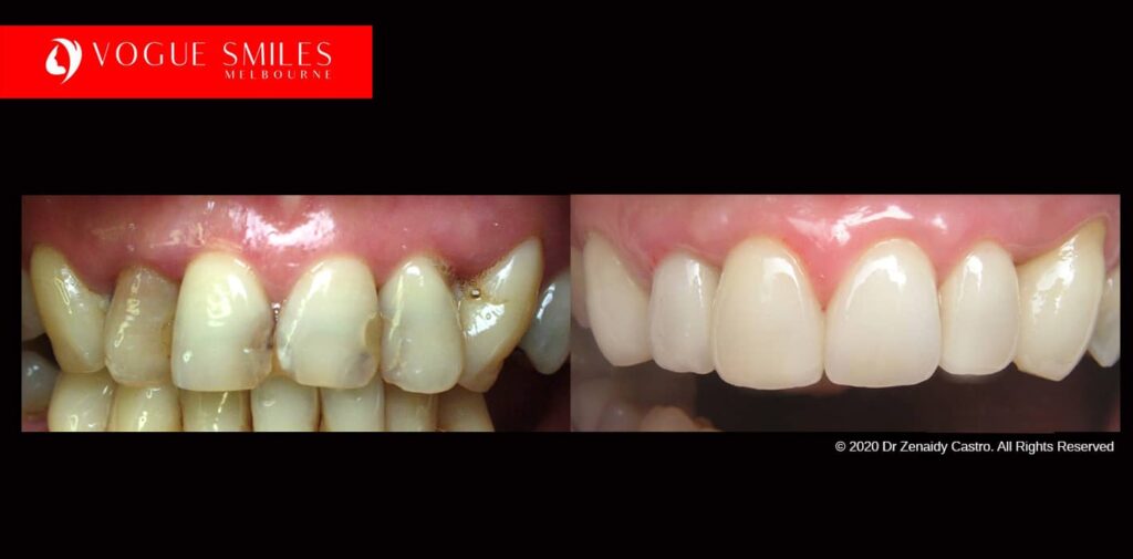 Full-Mouth-Reconstruction-complete-extreme-dental-makeover