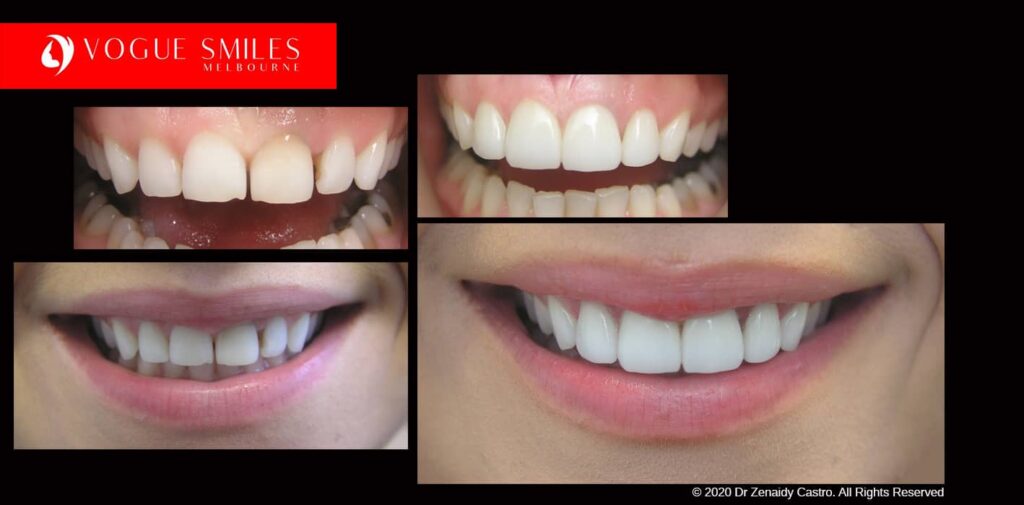 Full-Mouth-Reconstruction-complete-extreme-dental-makeover
