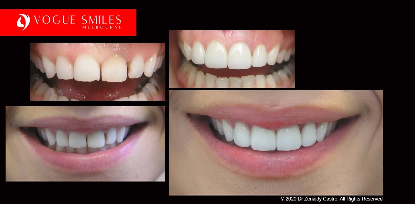 Prepless, No Grinding Porcelain Veneers Before and After