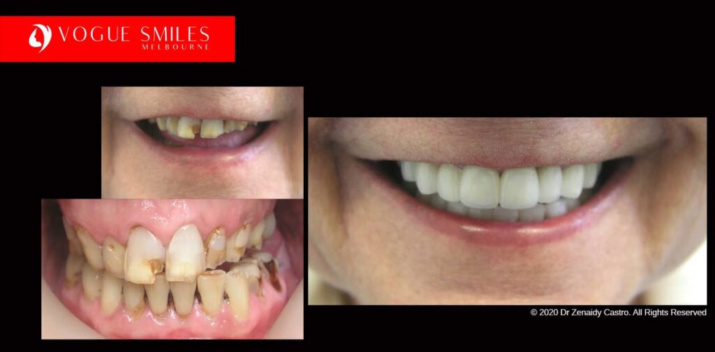 Full-Mouth-Reconstruction-complete-extreme-dental-makeover
