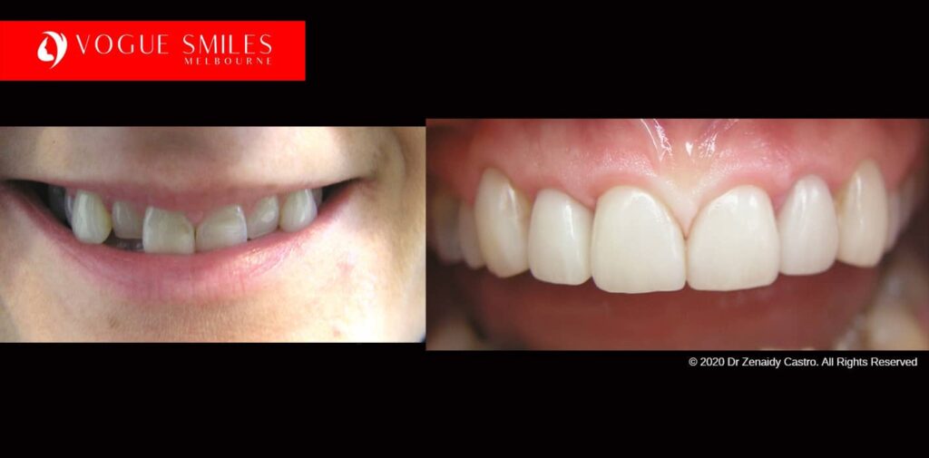 Full-Mouth-Reconstruction-complete-extreme-dental-makeover