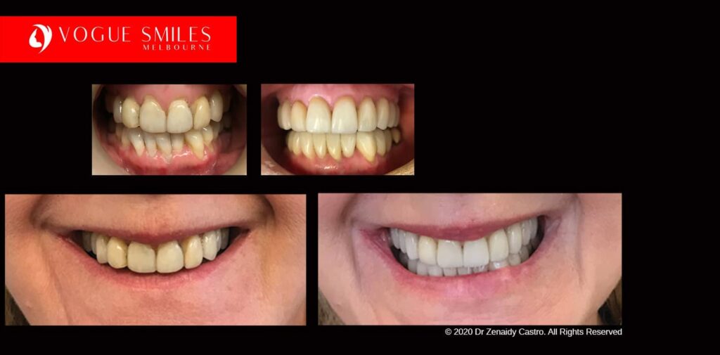 Full-Mouth-Reconstruction-complete-extreme-dental-makeover