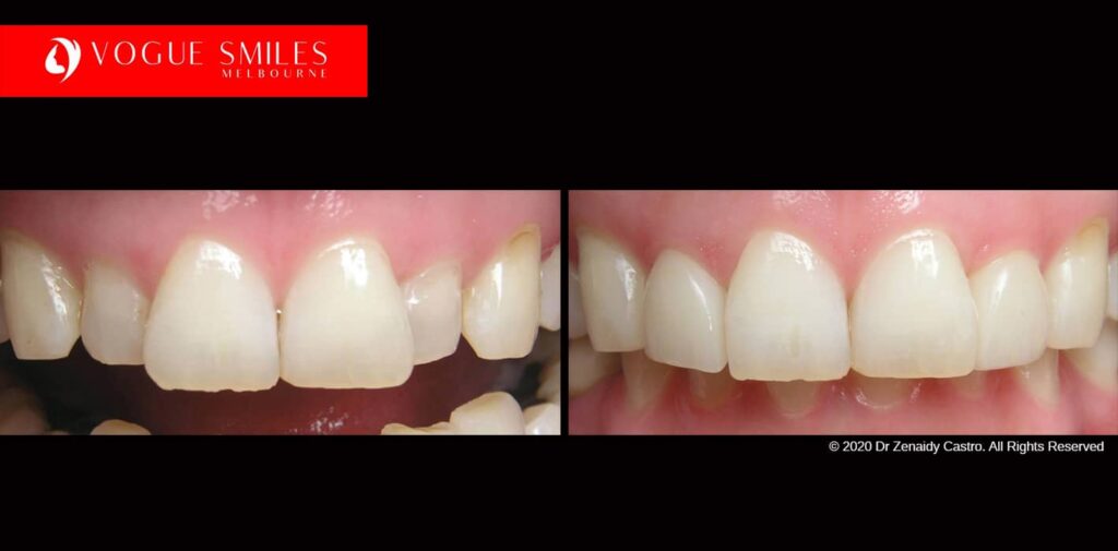 Full-Mouth-Reconstruction-complete-extreme-dental-makeover