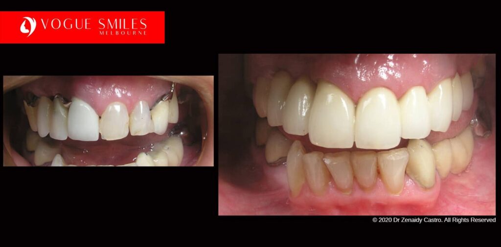 Full-Mouth-Reconstruction-complete-extreme-dental-makeover