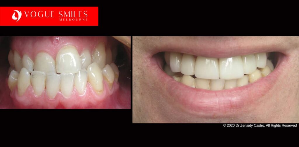 Full-Mouth-Reconstruction-complete-extreme-dental-makeover