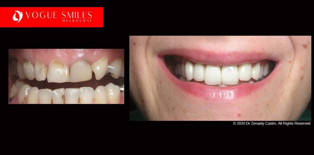 Full-Mouth-Reconstruction-complete-extreme-dental-makeover