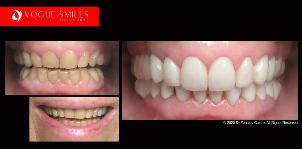 Full-Mouth-Reconstruction-complete-extreme-dental-makeover
