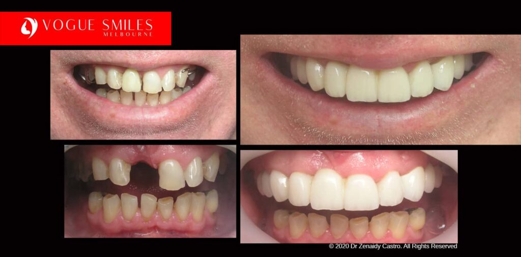 Full-Mouth-Reconstruction-complete-extreme-dental-makeover