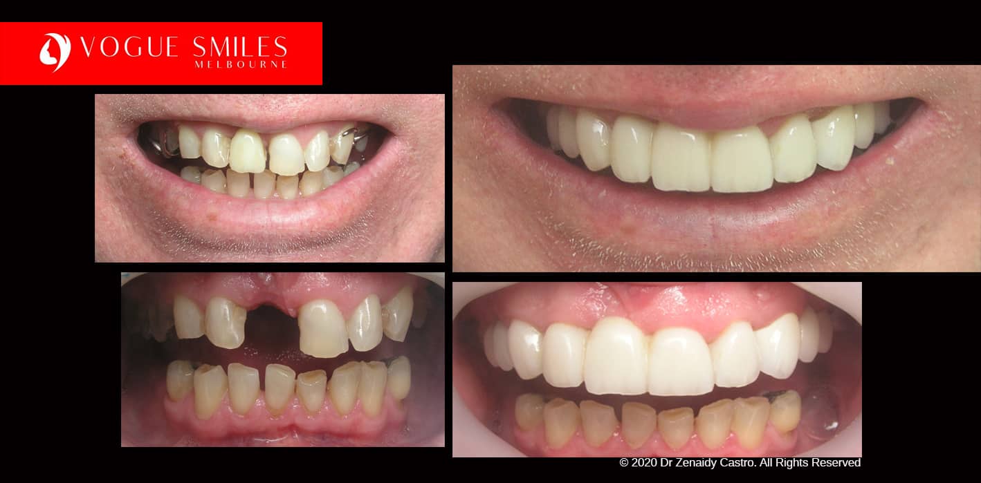 Dental Crowns and Dental Bridges Before and After