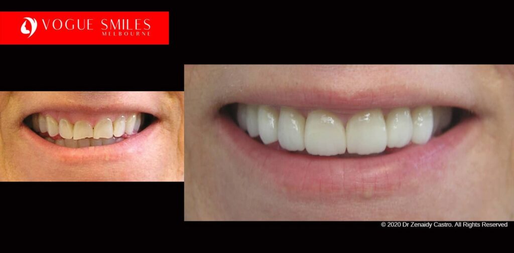 Full-Mouth-Reconstruction-complete-extreme-dental-makeover