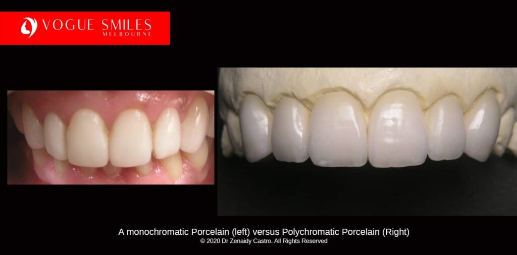 Full-Mouth-Reconstruction-complete-extreme-dental-makeover