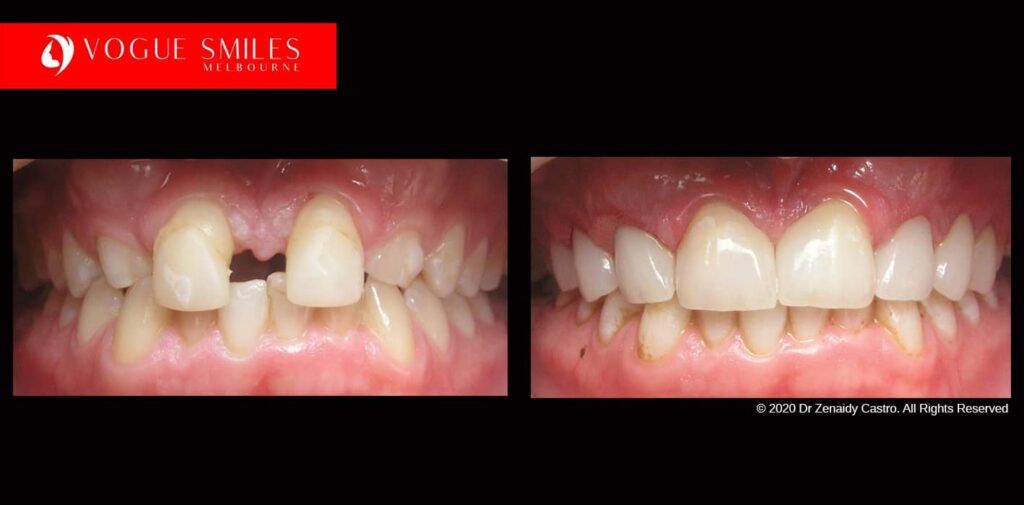 Full-Mouth-Reconstruction-complete-extreme-dental-makeover