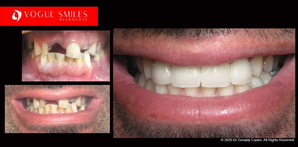 Full-Mouth-Reconstruction-complete-extreme-dental-makeover