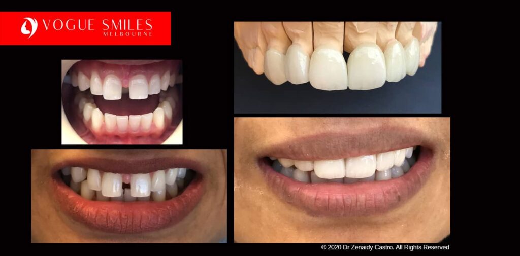 Full-Mouth-Reconstruction-complete-extreme-dental-makeover