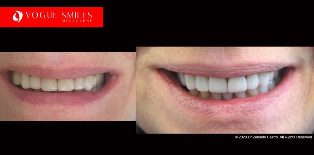 Full-Mouth-Reconstruction-complete-extreme-dental-makeover
