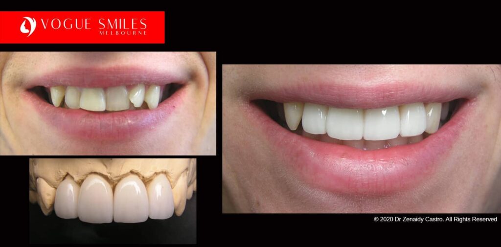Full-Mouth-Reconstruction-complete-extreme-dental-makeover