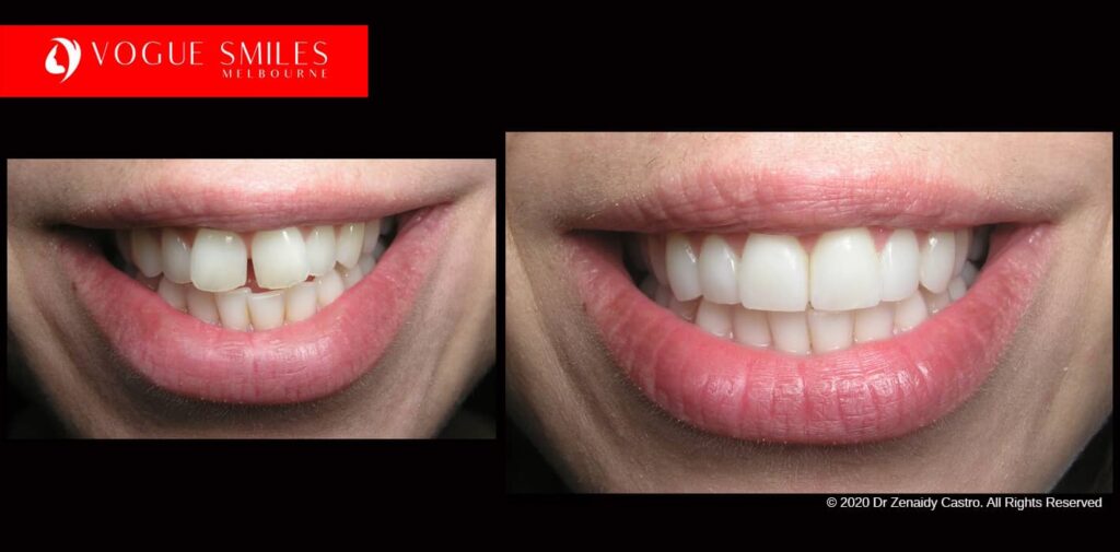 Full-Mouth-Reconstruction-complete-extreme-dental-makeover