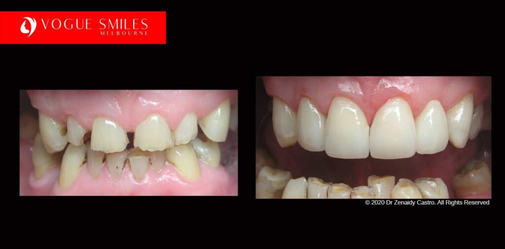 Full-Mouth-Reconstruction-complete-extreme-dental-makeover