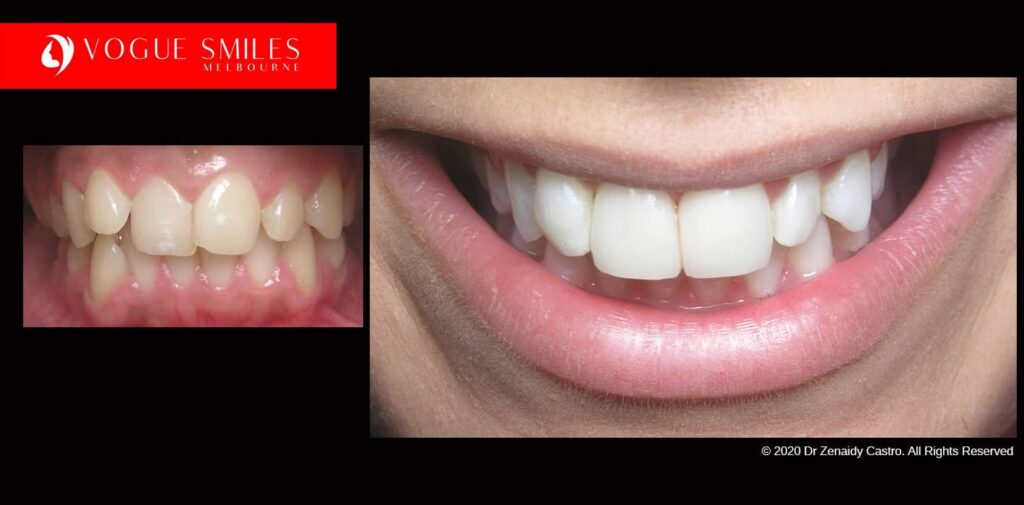 Full-Mouth-Reconstruction-complete-extreme-dental-makeover