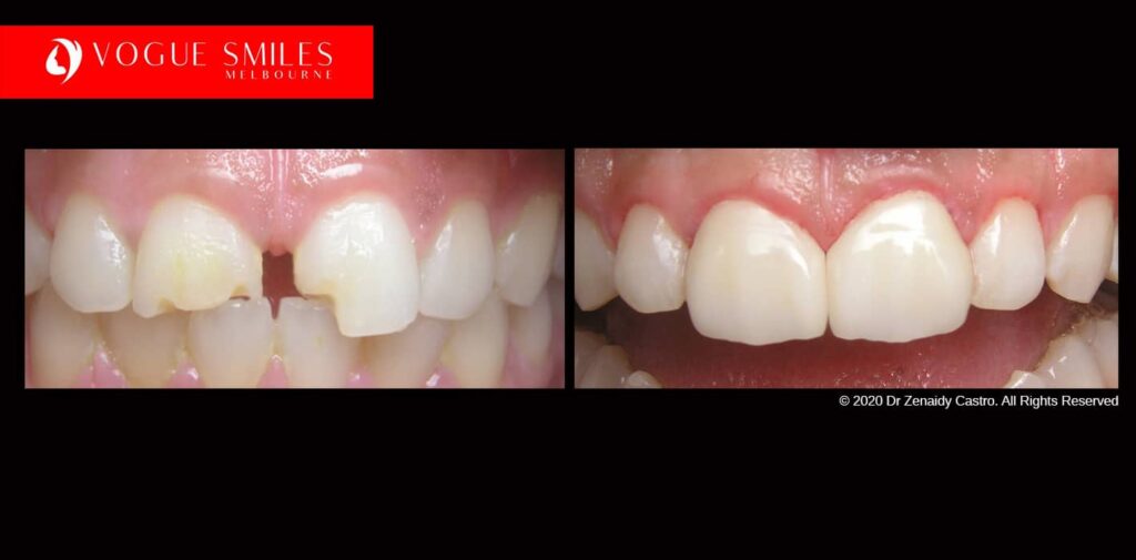 Full-Mouth-Reconstruction-complete-extreme-dental-makeover