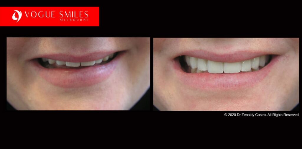 Full-Mouth-Reconstruction-complete-extreme-dental-makeover