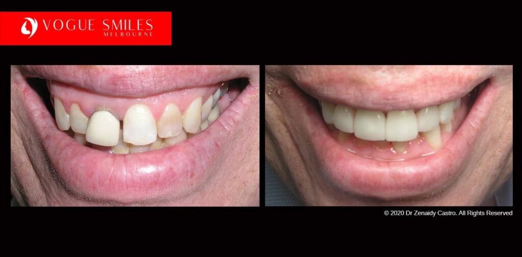 Full-Mouth-Reconstruction-complete-extreme-dental-makeover