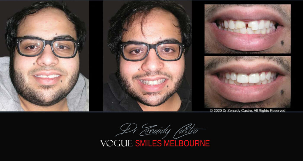 Close Gaps or Spacing Between Teeth Noble Park Dentist - Cosmetic Dental Clinic