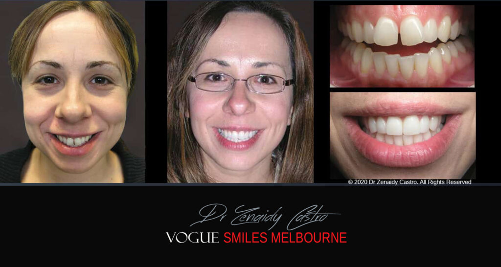 Close Gaps or Spacing Between Teeth Noble Park Dentist - Cosmetic Dental Clinic