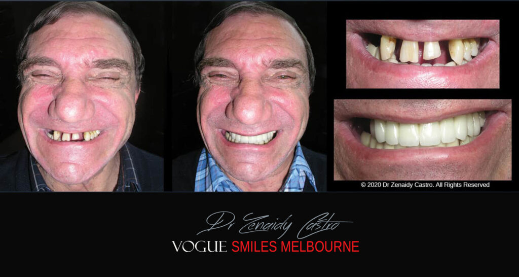 Close Gaps or Spacing Between Teeth Noble Park Dentist - Cosmetic Dental Clinic