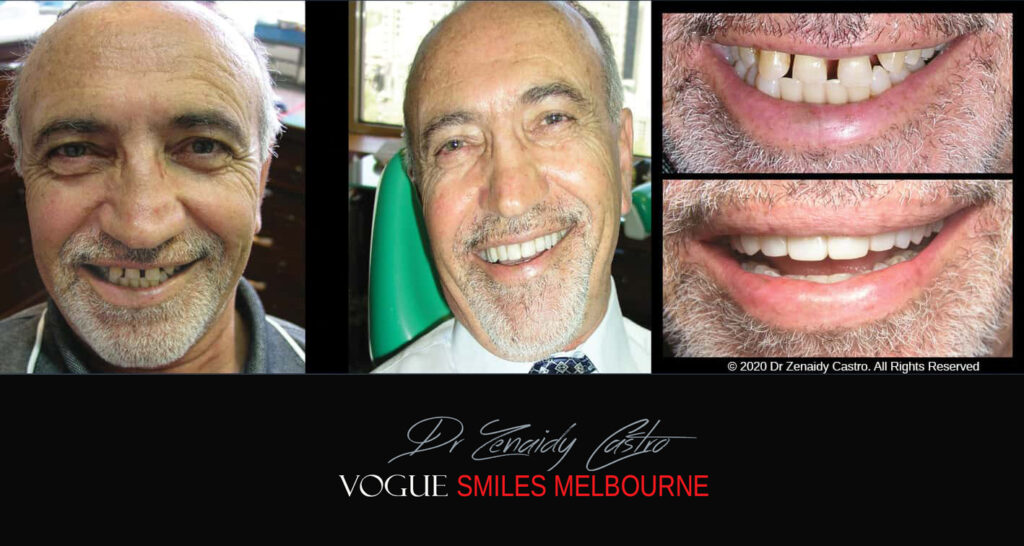 Close Gaps or Spacing Between Teeth Noble Park Dentist - Cosmetic Dental Clinic