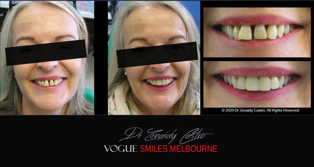 Close Gaps or Spacing Between Teeth Noble Park Dentist - Cosmetic Dental Clinic