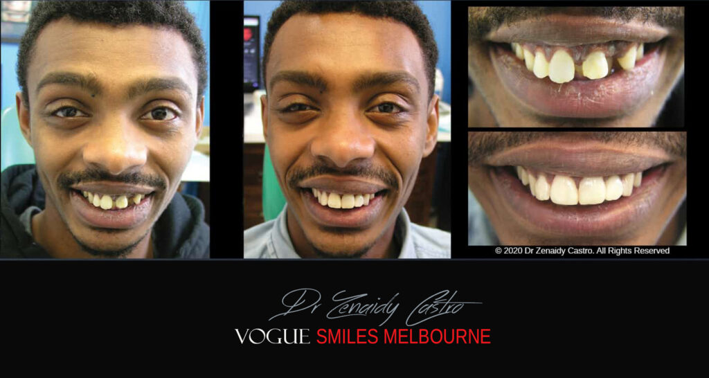Close Gaps or Spacing Between Teeth Noble Park Dentist - Cosmetic Dental Clinic