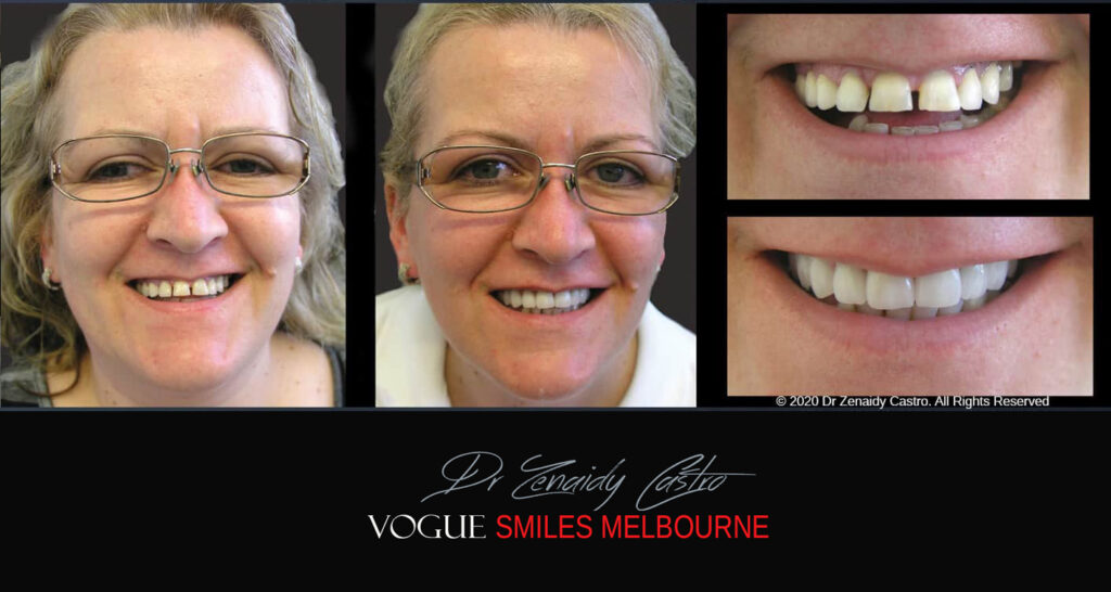 Close Gaps or Spacing Between Teeth Noble Park Dentist - Cosmetic Dental Clinic