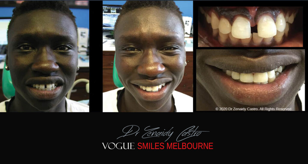 Close Gaps or Spacing Between Teeth Noble Park Dentist - Cosmetic Dental Clinic